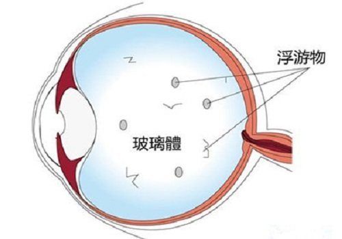 玻璃體渾濁用什么藥（玻璃體渾濁怎么辦） ?；?異型虎魚/純色虎魚 第1張